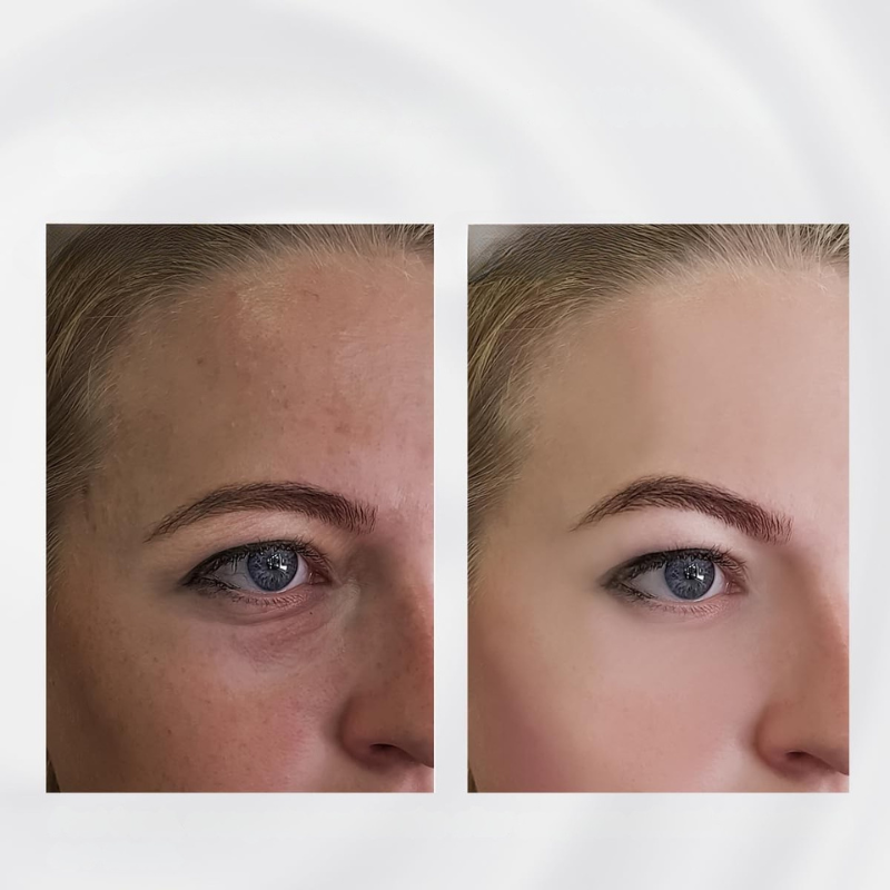Stainless Steel Skin Tightening Roller for Facial Firming