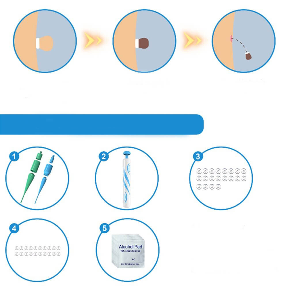 Skin Tag Removal Device with Precision Applicator